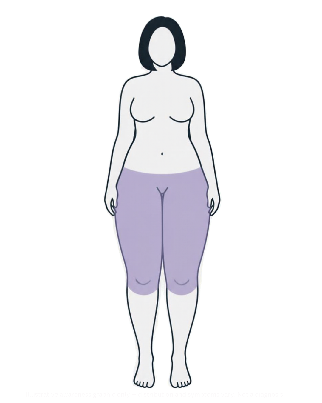 Lipedema Type II