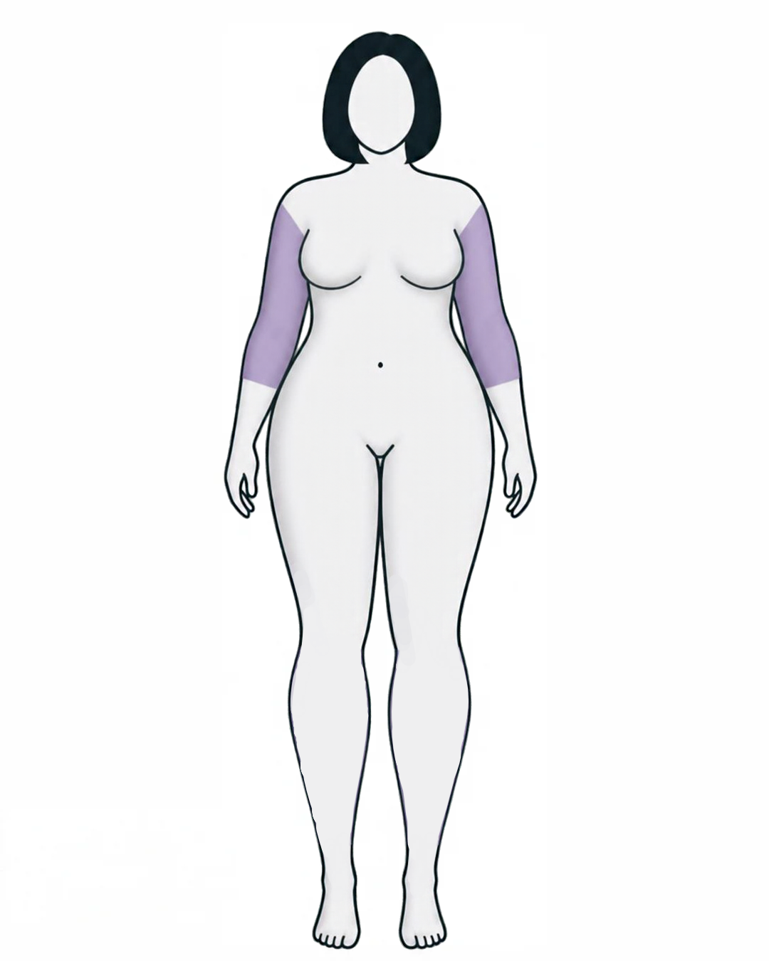Lipedema Type II