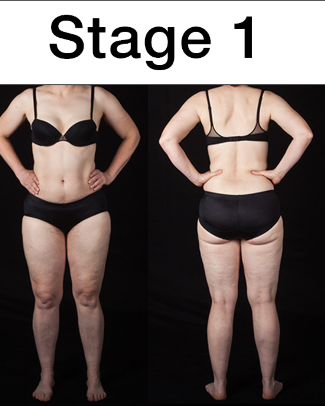 Illustration of Lipedema stage 1