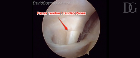 david.gusmao.ortopedia.tendao.musculo.psoas.anormal.Intra-articular.quadril