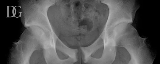 david.gusmao.ortopedia.impacto.femoroacetabular.atleta