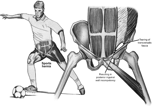 Hérnia do esporte, Sports Hernia