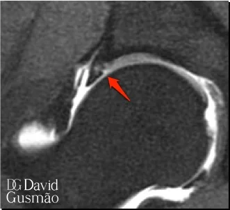 RNM_ruptura_labral