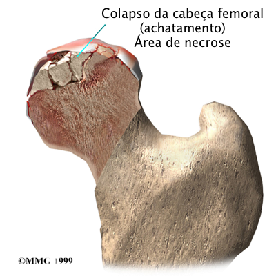 colapso cabeça femural.png