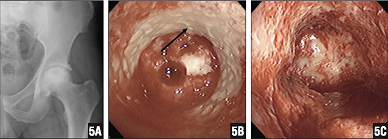 Na figura 5A pode se ver a lesão de osteonecrose, um alo branco dentro da cabeça femural com centro escuro. A seta na figura 5B demonstra o osso esclerótico(branco) e sem irrigação sangüínea. Na figura 5C o osso sem irrigação foi removido. Será colocado enxerto ósseo no local acometido. Brannon, James K. 2012. “Nontraumatic Osteonecrosis of the Femoral Head: Endoscopic Visualization of Its Avascular Burden.” Orthopedics 35(9): e1314–22.