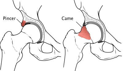 Esquerda: excesso de osso na borda do acetábulo (osso da bacia, pelve); Direita: excesso de osso na cabeça femoral, fazendo com que fique ovalada. Causa excesso de atrito ao realizar movimentos de rotação.
