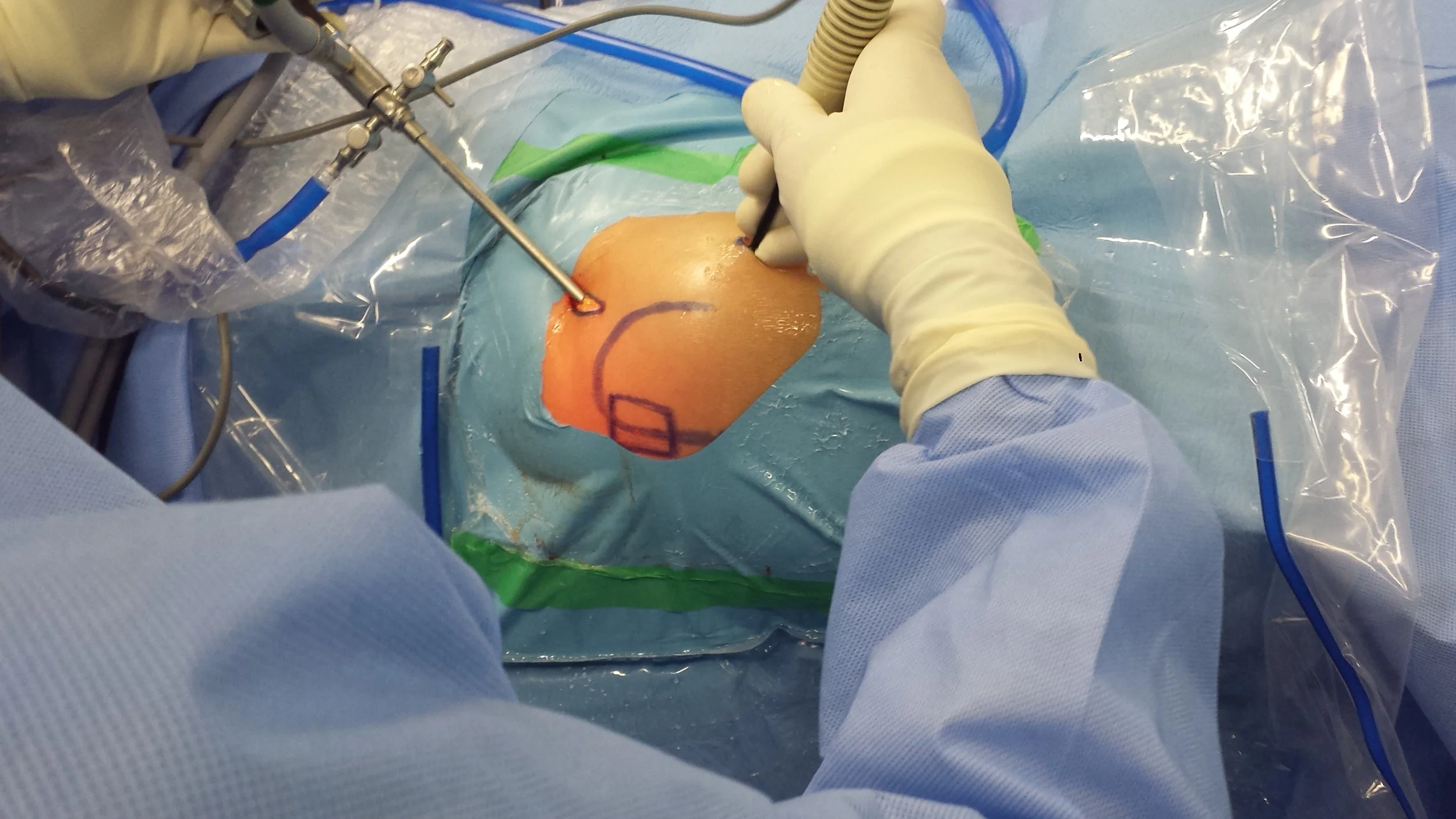Foto de uma cirurgia de videoartroscopia de quadril