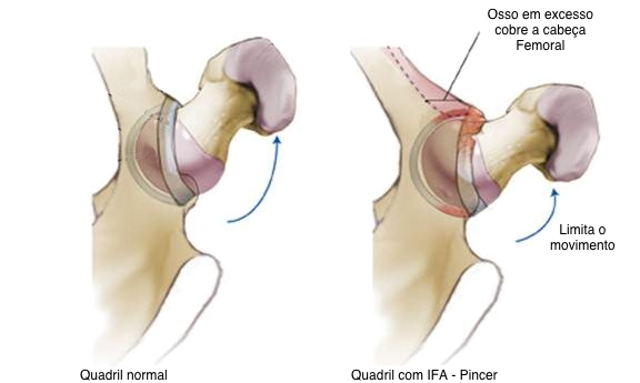 Quadril visto de cima. Esquerda: quadril normal com boa amplitude de movimento sem atrito. Direita: quadril com impacto femoroacetabular tipo pincer. Ao realizar movimentos de rotação ocorre o choque (impacto) do fêmur contra a borda do osso da bacia (acetábulo)
