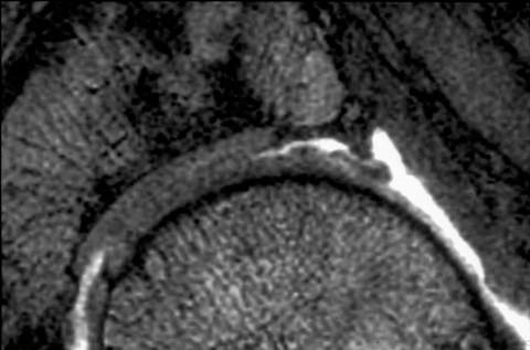 Figura 2 - Lesão da cartilagem vista em Ressonância Nuclear magnética do quadril
