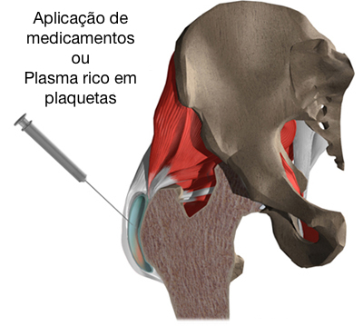 Aplicação de medicação anti-inflamatória ou de plasma rico em plaquetas.