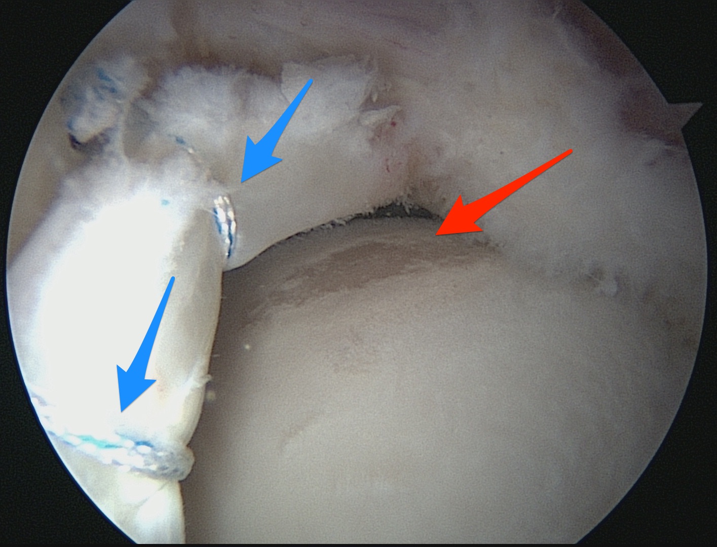 Exemplo de um caso onde o labrum (tipo menisco um menisco do quadril) do paciente foi suturado (setas azuis), porém o paciente já apresentava grau avançado de artrose. A seta vermelha mostra que na cabeça do femur, já não existe mais cartilagem. É muito provável que o alivio da dor dure pouco tempo devido a esse achado durante a cirurgia. 