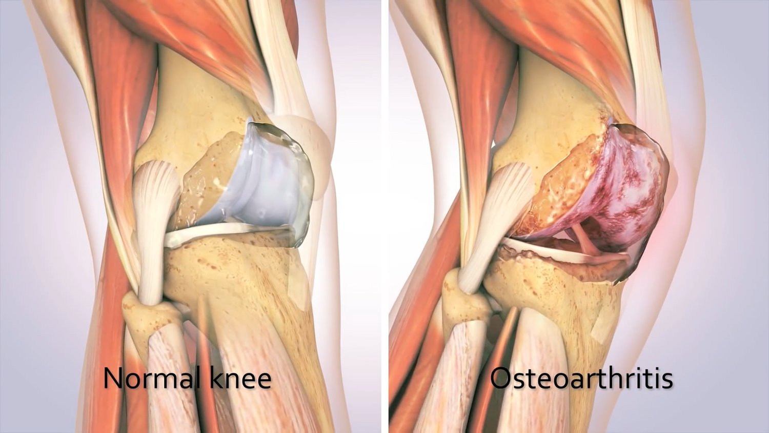 artroza ce tratament cartilajul articulației genunchiului s a decolorat