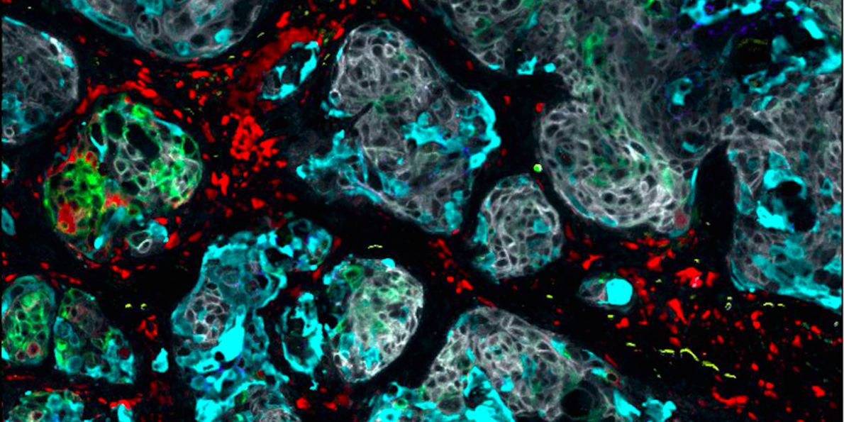 Google Teams Up With NHS To Inject AI Into Head And Neck Cancer Treatment