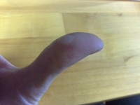 I think I have discovered a new systematic type of injury. It is commonly acquired from assembling cheap furniture with the poor quality tools that are provided. I call it Ikea; Thumb.