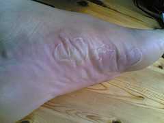 02052006(001)
Originally uploaded by jkprime .
And here is the downside to all that running.