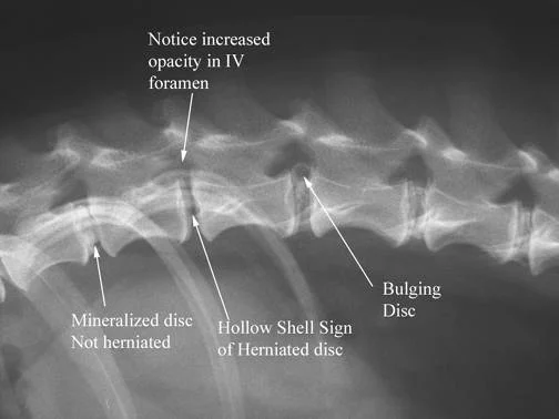 An example of IV Disc Disease