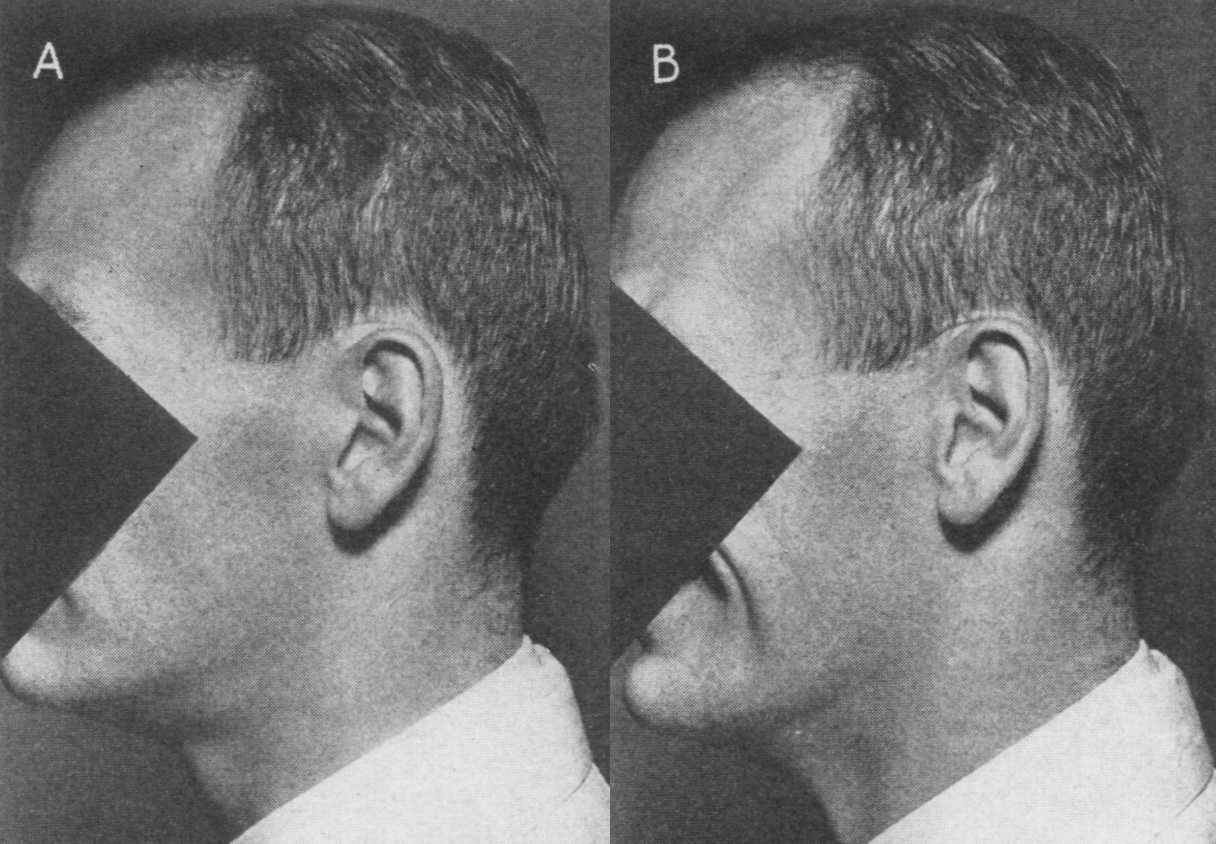 Image : The Theory of The Pathogenesis of Ordinary Human Baldness (1950)