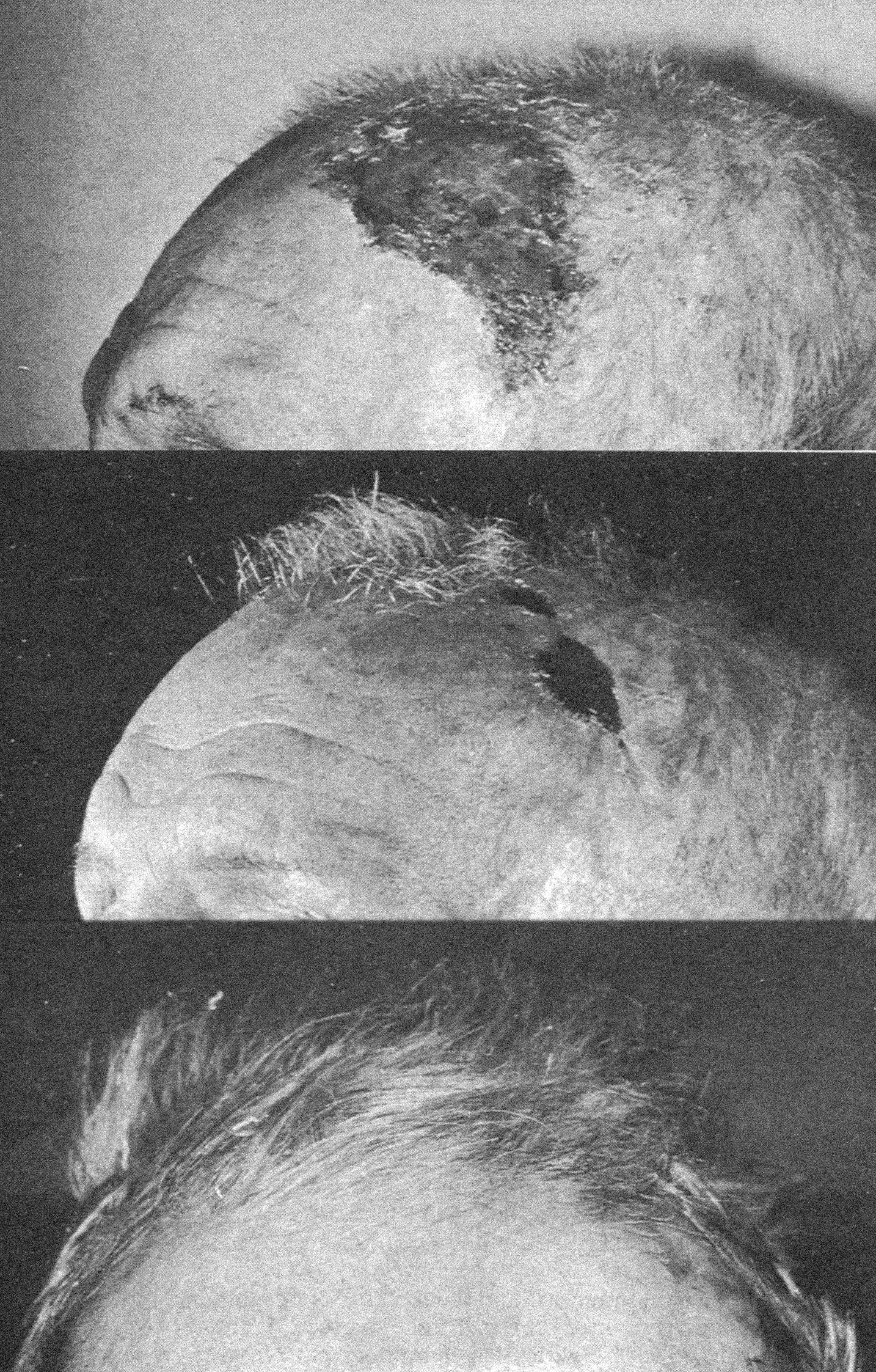 Image : A 78 year old man with common male pattern baldness was dozing in his armchair when he fell head first into a coal fire.