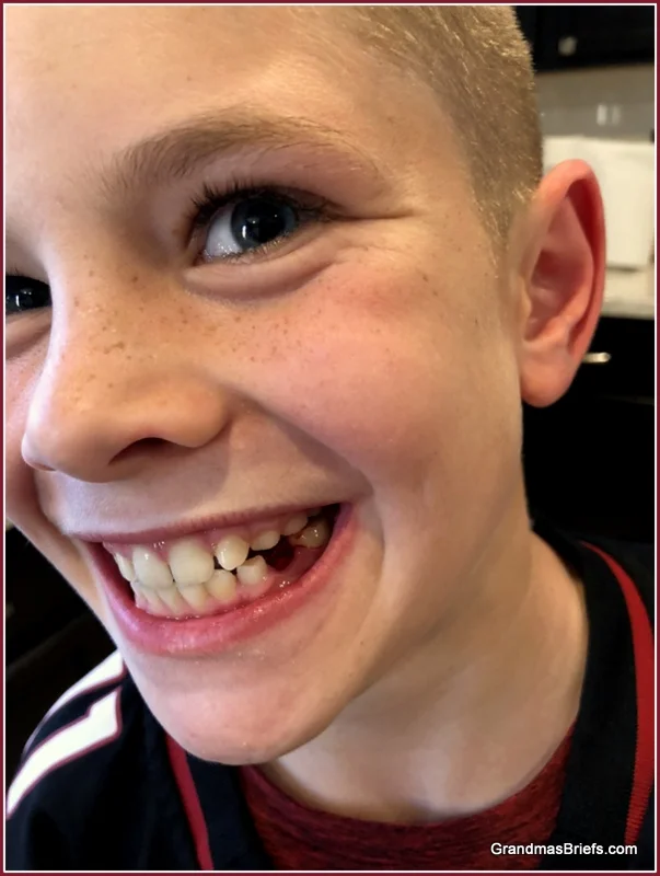 Word of the day: Freckles