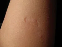 Mystery of the scar