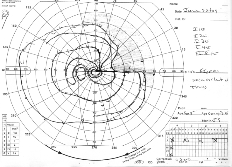 Glaucoma Consults Round-up: Progression on Goldmann VFs but is it Glaucoma?...and more!
