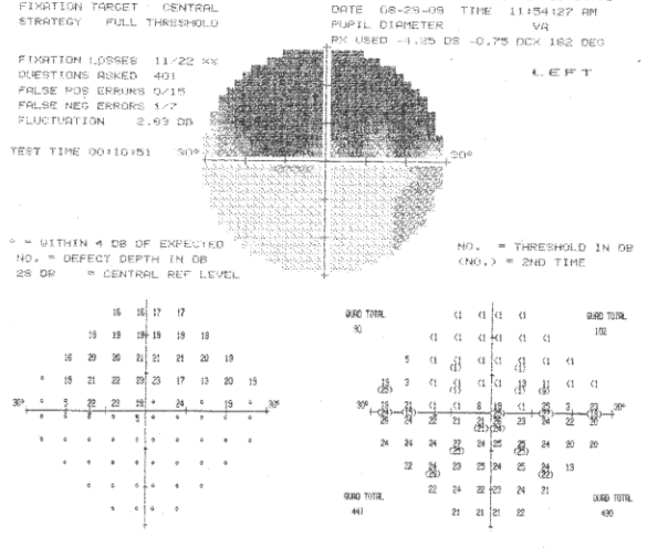 Glaucoma Consults Round-up: When to treat narrow angles and too little too late.