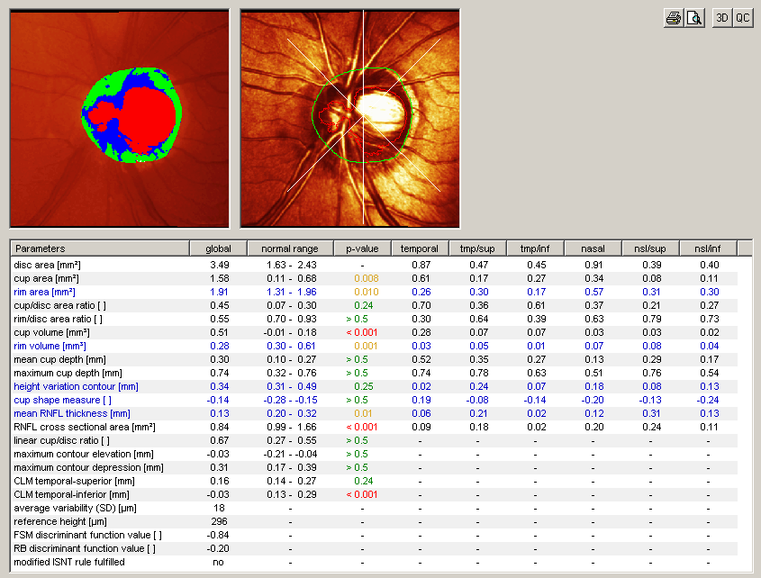 Glaucoma Consults Round-up - Toxic beta blockers, red hot eyes and more