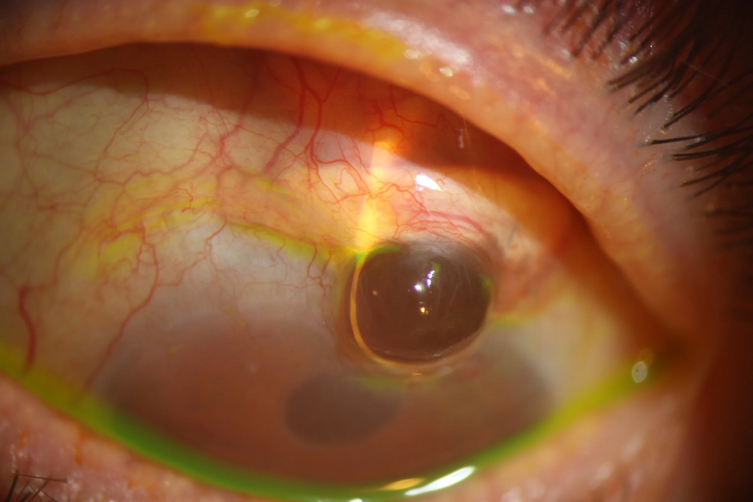 Uveal prolapse at surgical margin Ahmed GV