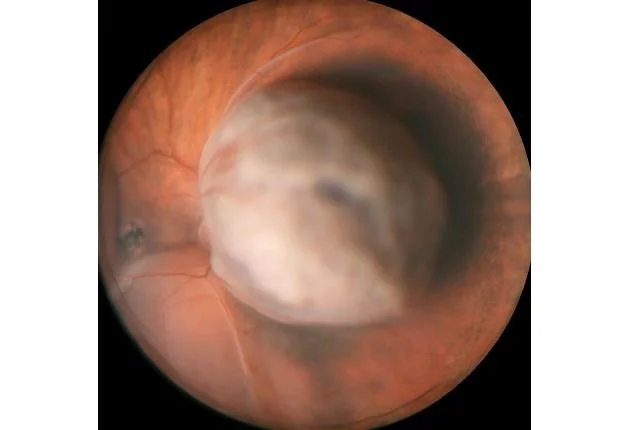 0935 hrs: Review of Clinical Diagnosis of Choroidal Melanoma - Tara McCannel