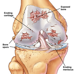 Knee Cartilage.png