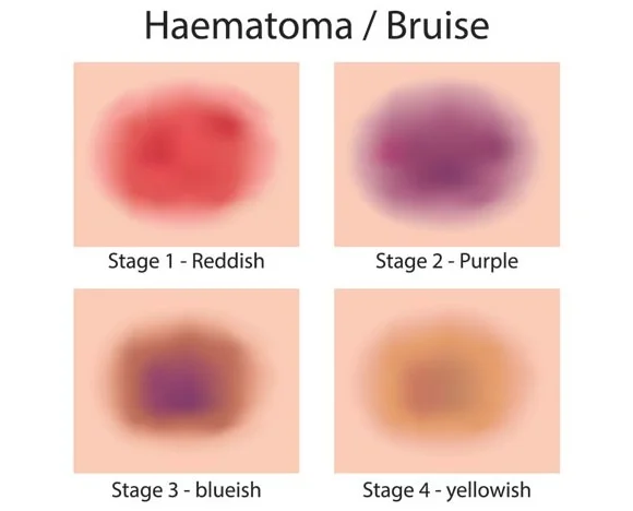 Bruise.jpg