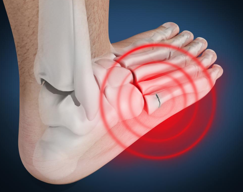 Lateral Foot Pain Max Remedial Massage And Therapy