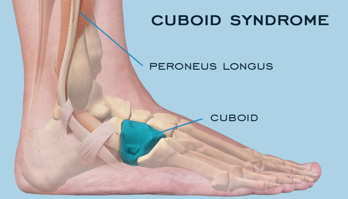pain in side of foot near heel