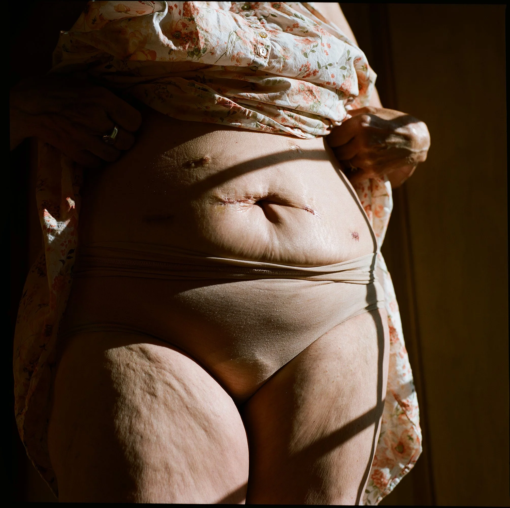 JG_Mom2025_HystorectomyScars_001_LR.jpg