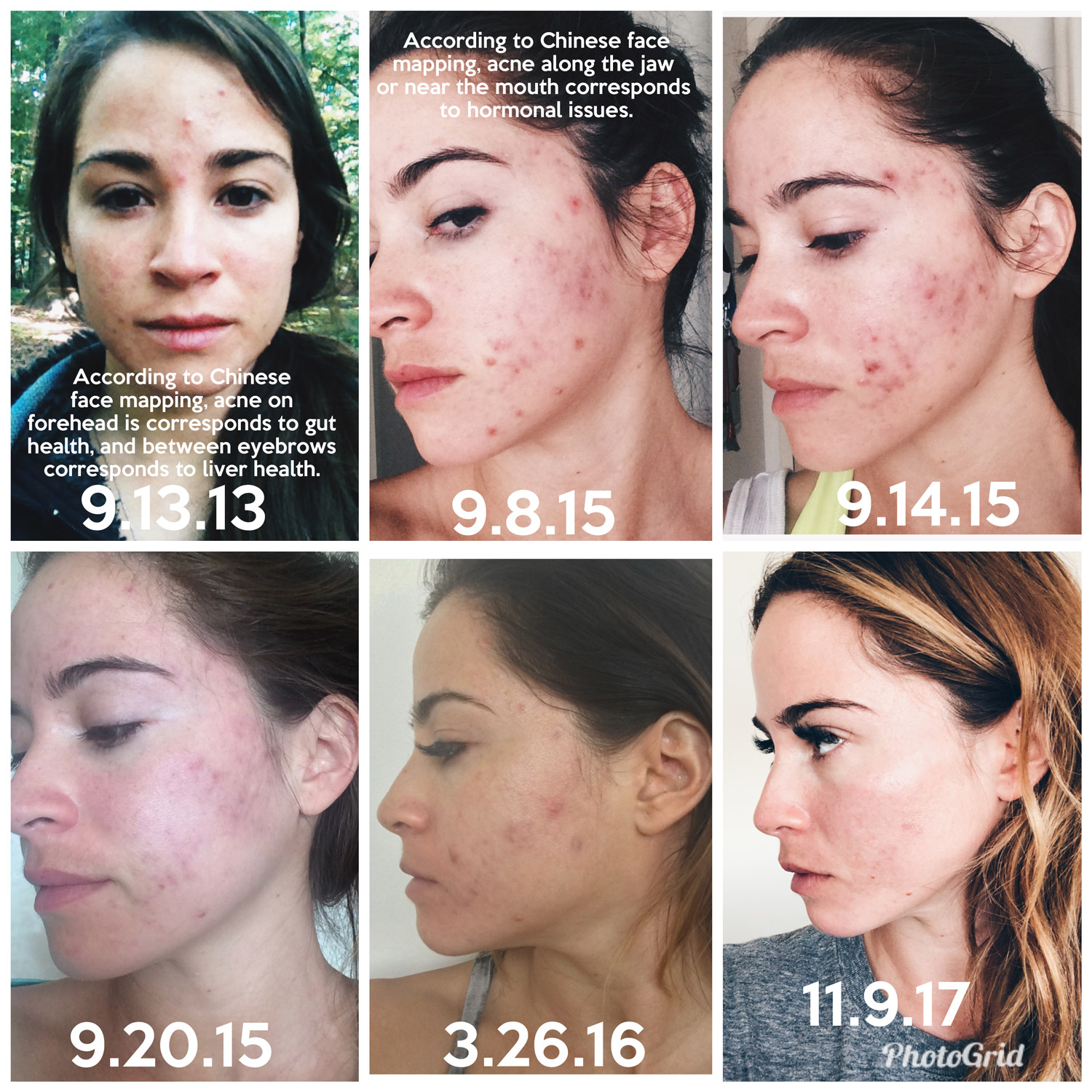 How I Got Hormonal Acne Under Control — Yogabycandace