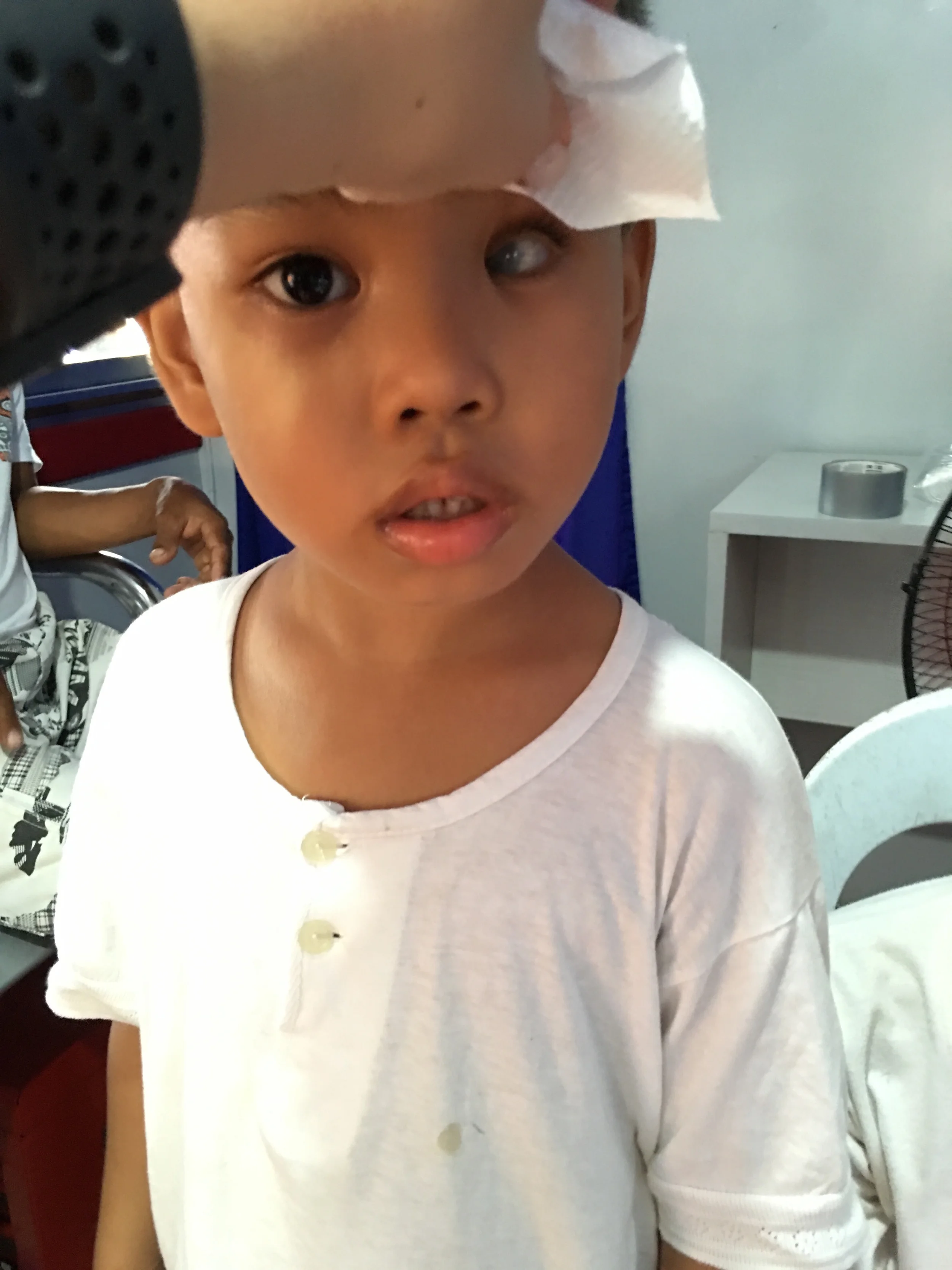 This 6-year-old boy has unfortunately gone blind in his left eye due to congenital glaucoma.
