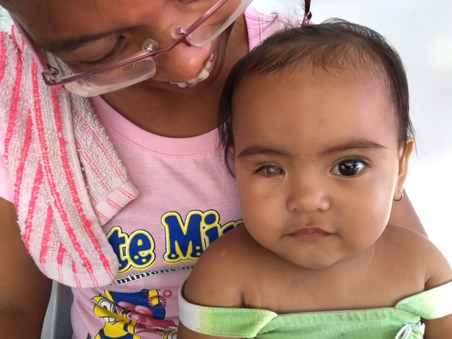 This 10-month-old baby girl has congenital glaucoma in her right eye. Her mother noticed that her eye started to look like "mata ng pusa" soon after birth, which means "cat's eye." She was referring the baby's iris not developing properly, a condition common in congenital glaucoma.