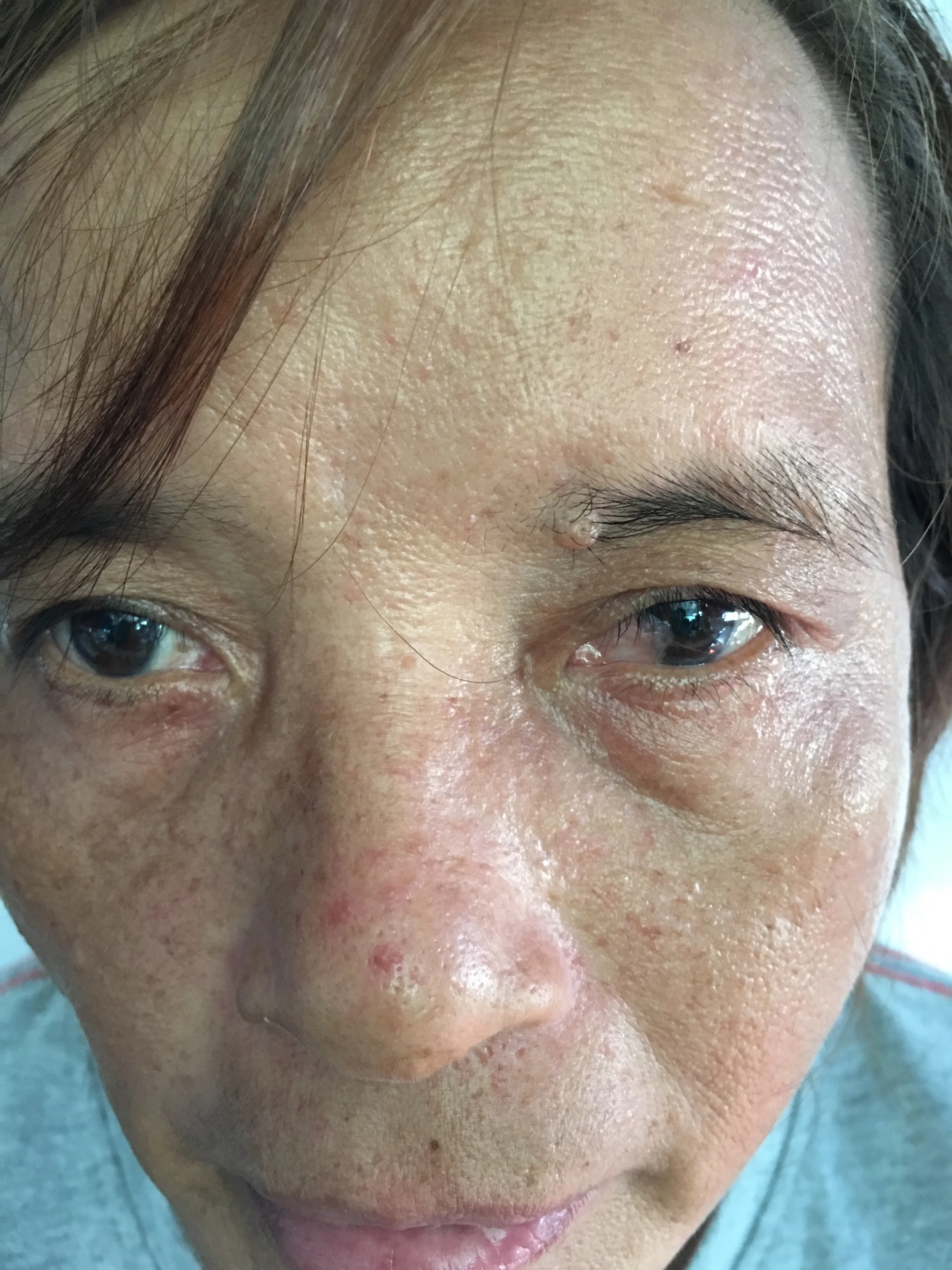 This woman was losing her vision due to pterygium growth over her left eye due to exposure to wind, sun and dust. She was scheduled to have it removed. Once removed, she will regain normal vision.