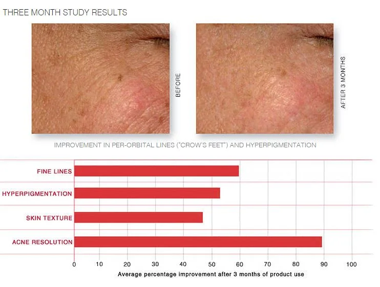 RENEW SERUM RESURFACES FINE LINES, LIGHTENS HYPERPIGMENTATION, REFINISHES SKIN TEXTURE, RESOLVES ACNE