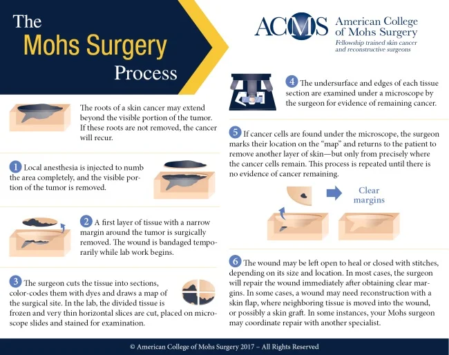 ACMS-Mohs-Surgery-Process-Infographic-Square-650px.jpg