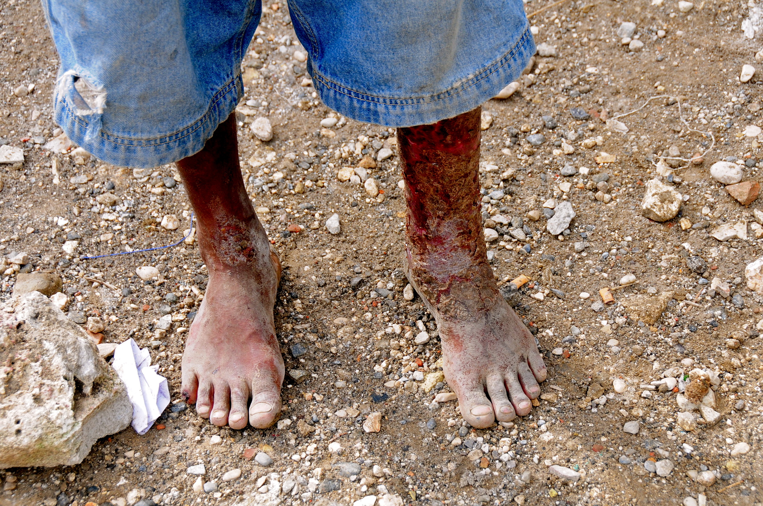 Man with infected legs waiting to be seen at the amputee center