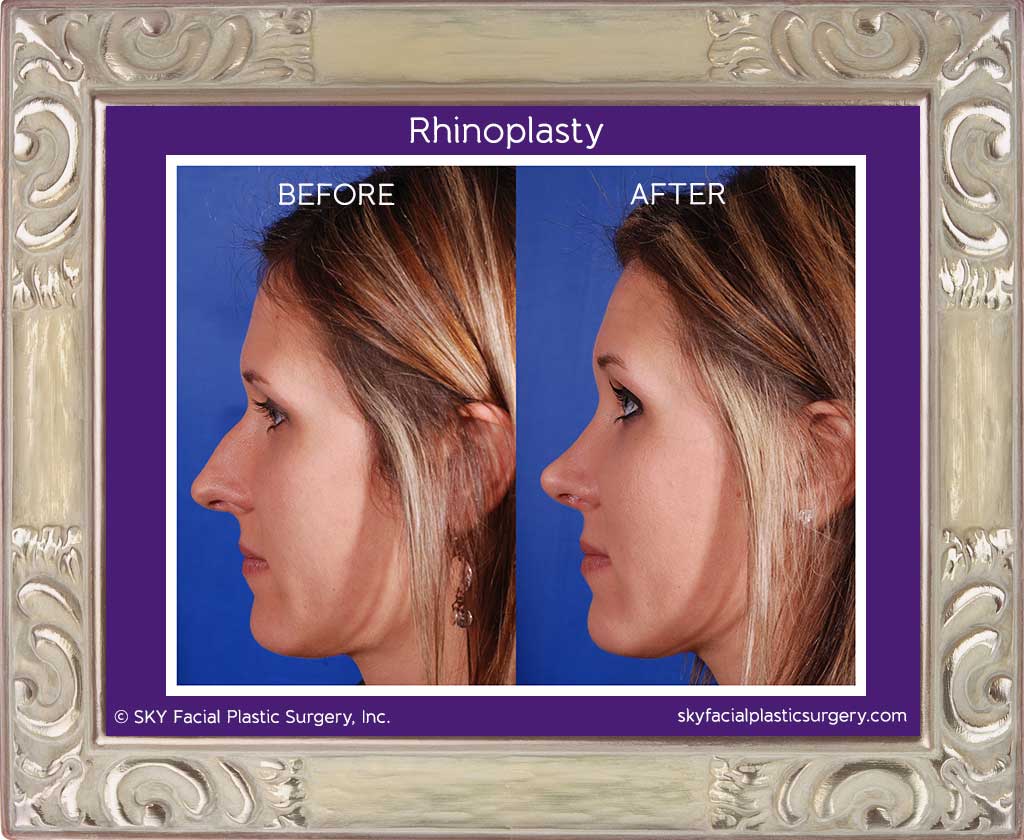 Rhinoplasty - San Diego