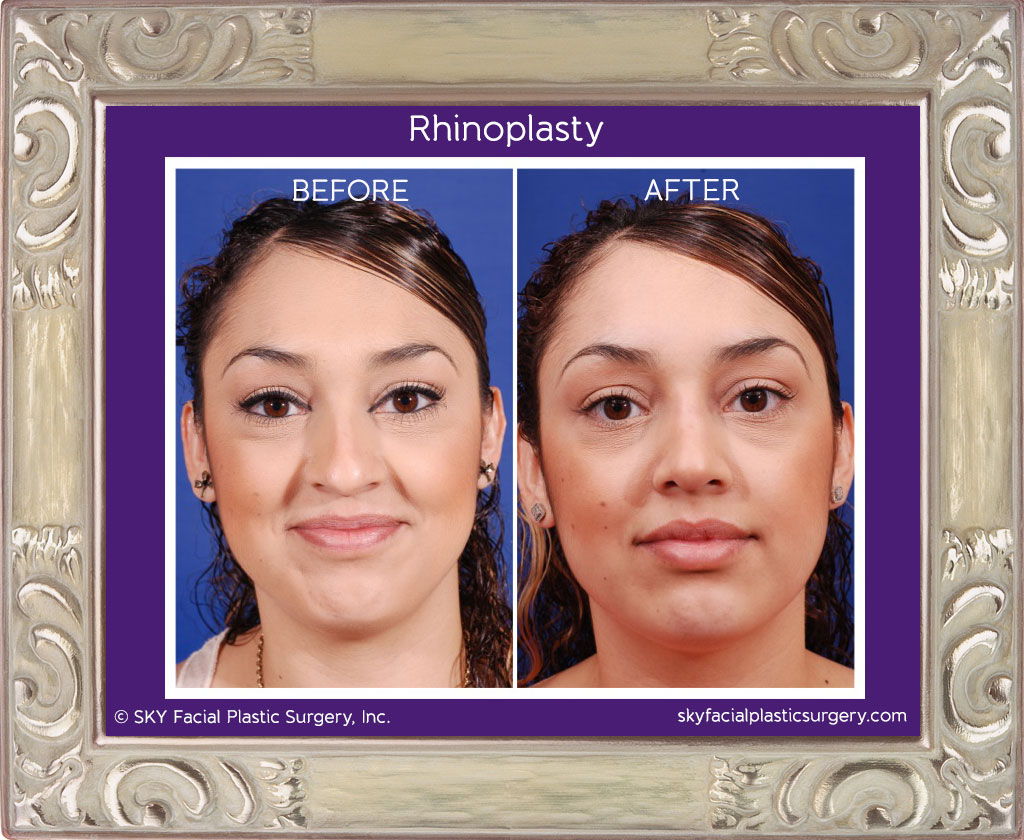 Rhinoplasty - San Diego