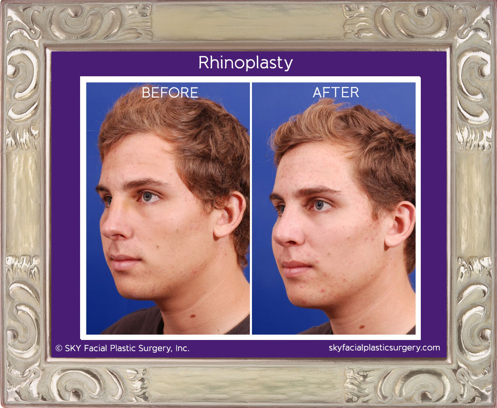 Rhinoplasty - San Diego