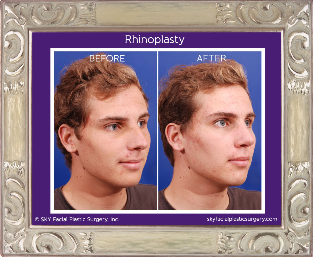 Rhinoplasty - San Diego