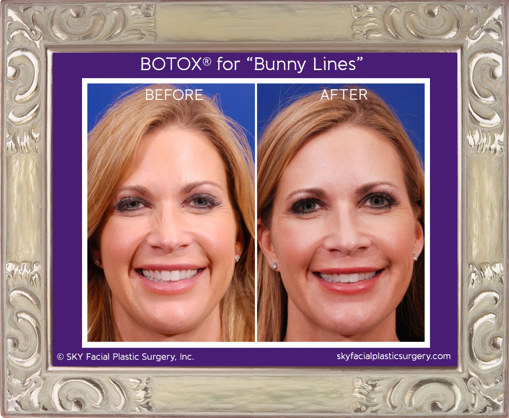 Botox to treat "Bunny Lines"