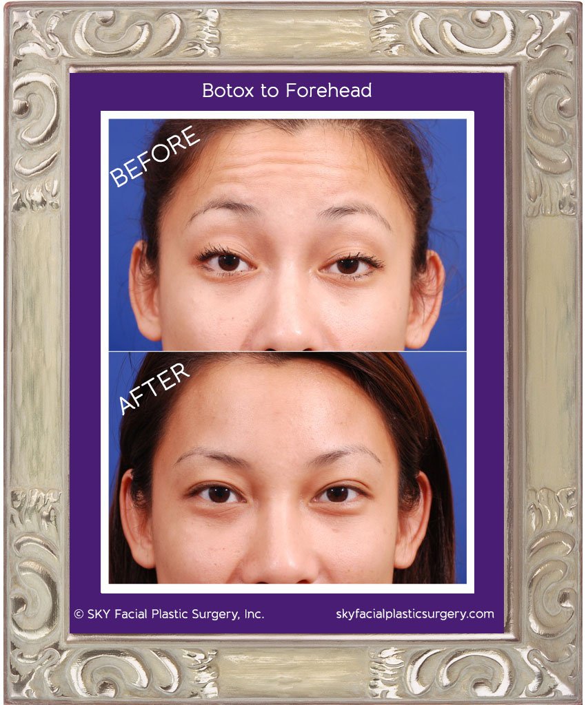 Botox for forehead wrinkles