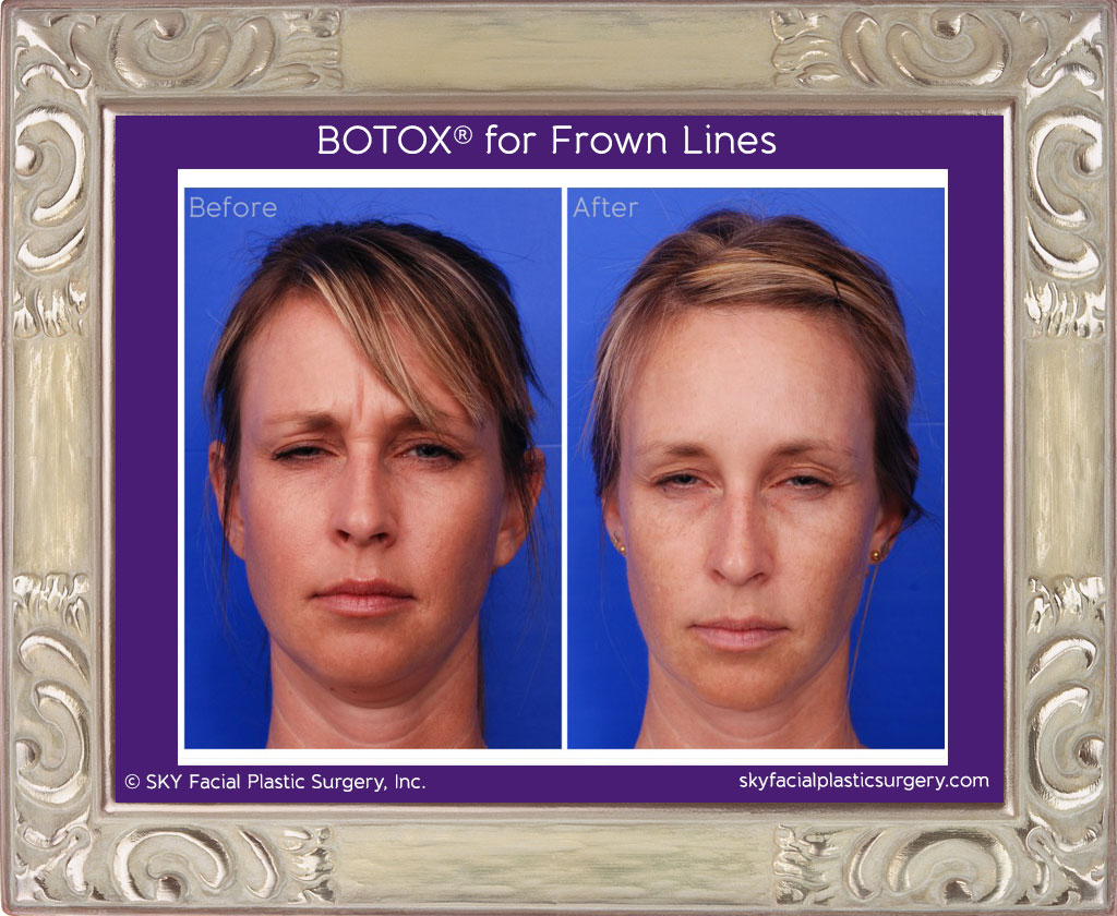 Botox for frown lines