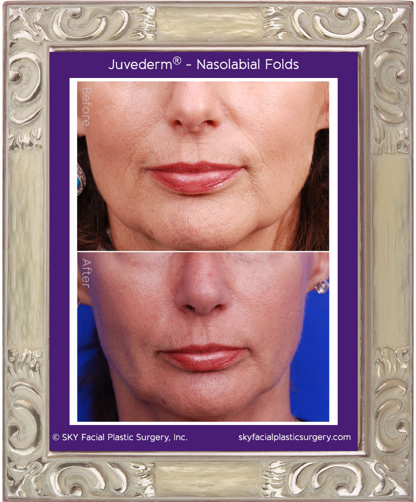 Juvederm used to fill nasolabial folds