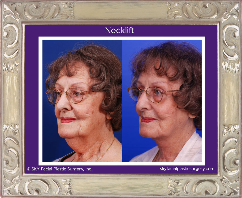 Neck Lift